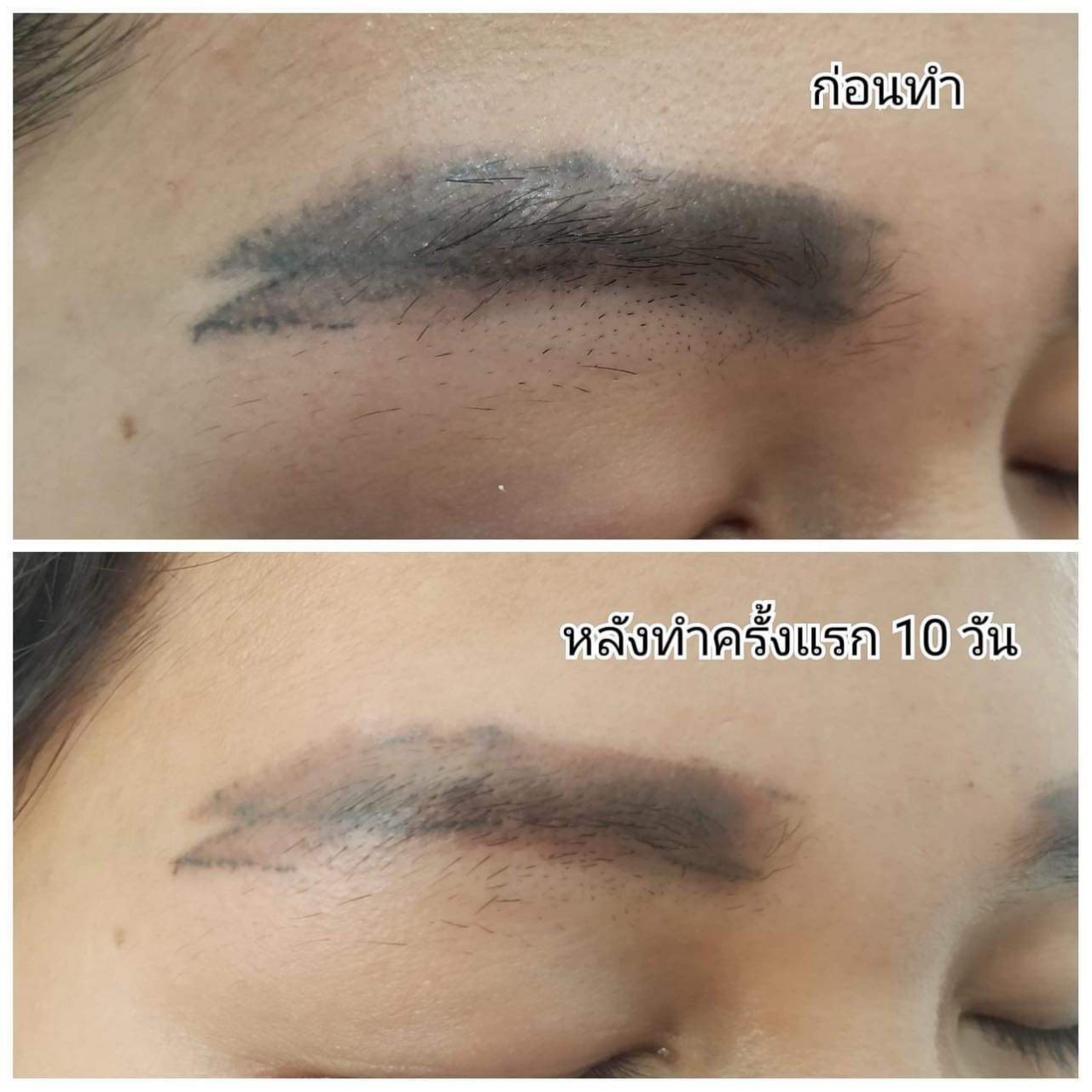 04495FDF-B957-43BB-BD66-58BE2835F87B.jpg - เลเซอร์ลบสีสัก | https://jdebrows-studio.com