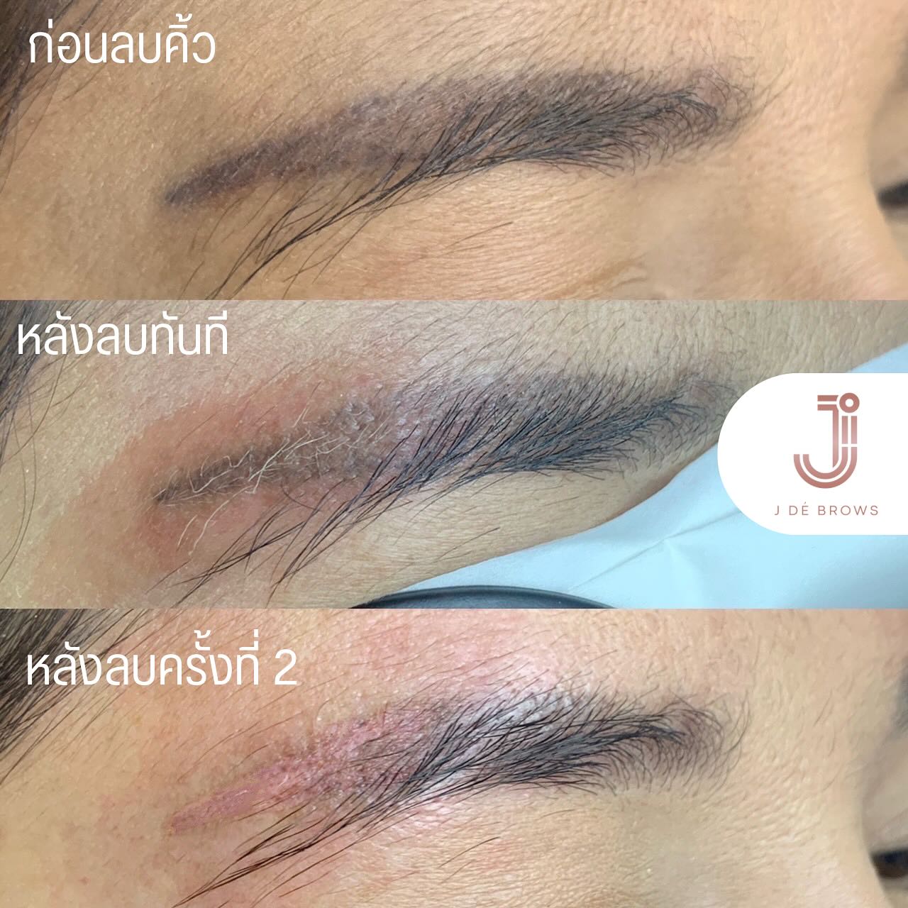 464228252_18023973824439343_1104035532846467864_n.jpg - เลเซอร์ลบสีสัก | https://jdebrows-studio.com